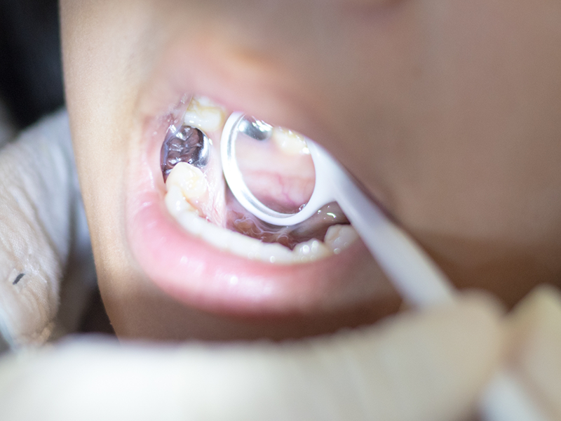 Close up of a dental mirror inside of a child's mouth