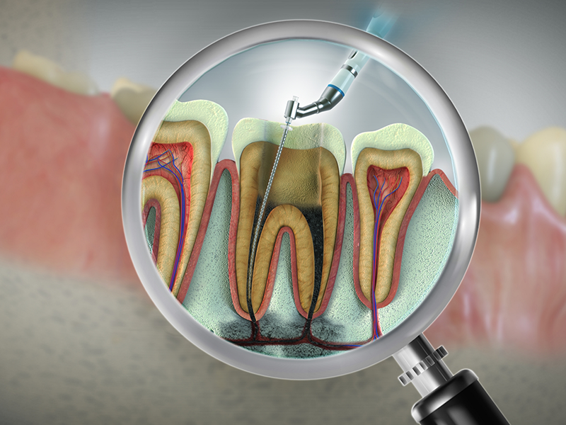 Illustration of a decayed tooth