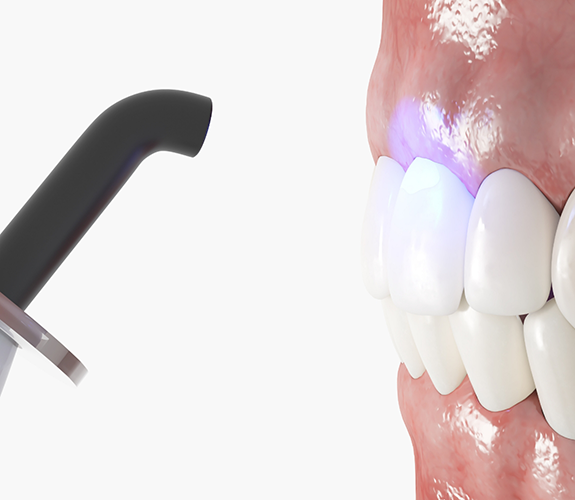Illustration of an ultraviolet light shining onto a tooth