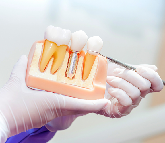 Dentist holding a model of a dental implant compared to natural teeth