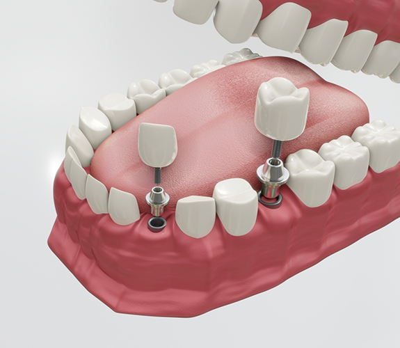 Illustration of two dental implants being placed in the lower jaw
