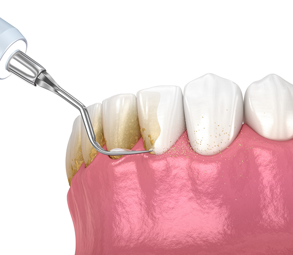 Illustration of a dental scaler clearing tartar from the teeth
