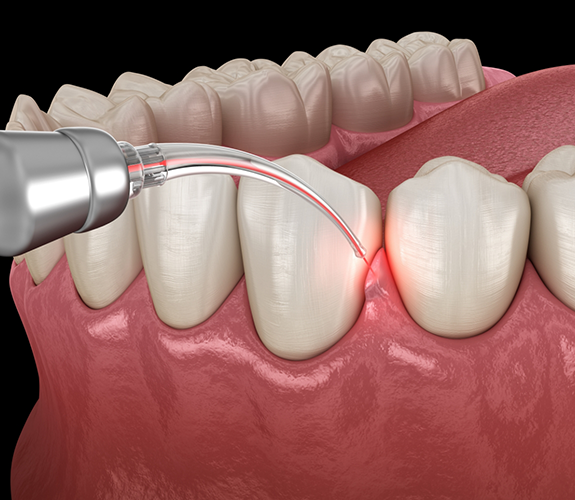 Illustration of a laser treating the gums