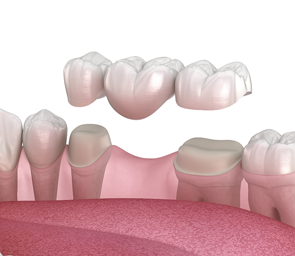 Illustration of a dental bridge replacing a missing tooth
