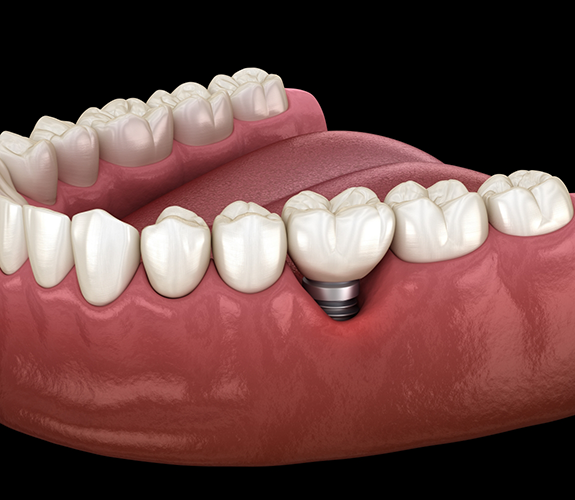 Illustration of a dental implant replacing a missing tooth