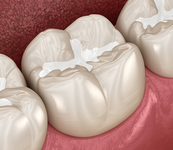 Illustration of a tooth with a white filling