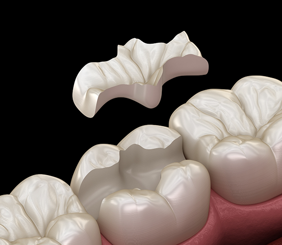Illustration of an inlay being placed to restore a broken tooth