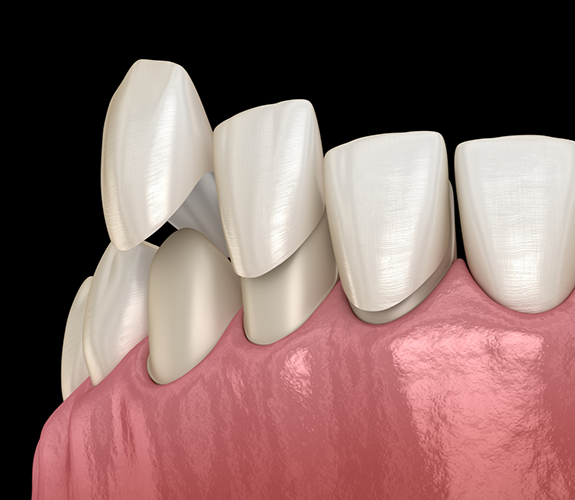 Illustration of veneers covering the front of several teeth