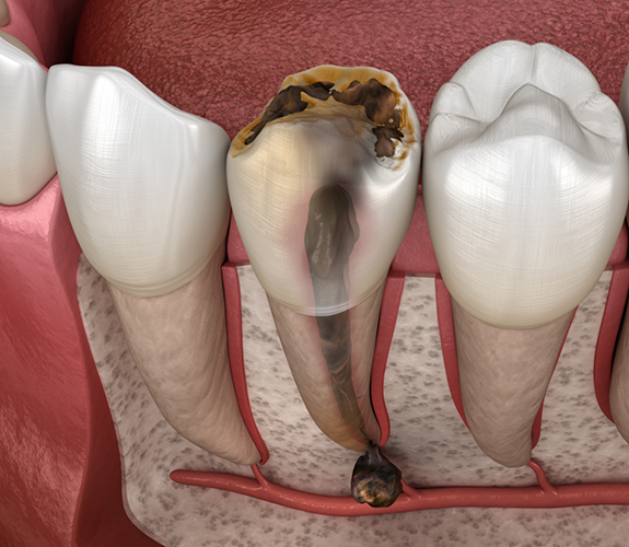 Illustration of a badly decayed tooth