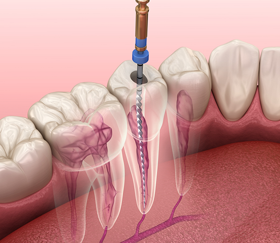 Thin dental instrument treating the center of a tooth
