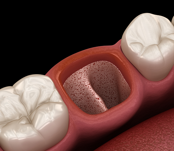Illustration of an empty space in the mouth after a tooth extraction